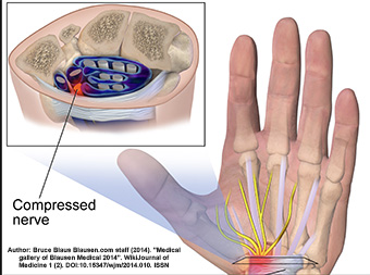 Bilateral Carpal Tunnel Results in Workers' Compensation Total Disability