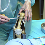 Preventing Joint Replacement Surgery in Workers' Compensation Claims